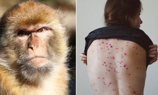 الصحة تكشف طرق انتشار جدرى القرود.. أبرزها الملابس الملوثة