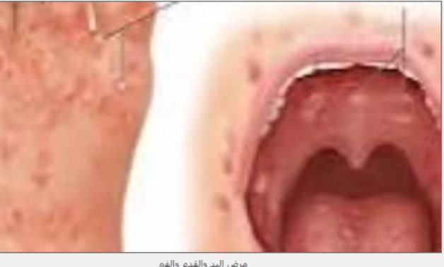 تعليق الدراسة فى عاصمة بيرو.. فيروس كوكساكى يثير الذعر
