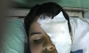 الطفل المصاب بفقء عينه على يد زميله بمدرسة